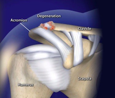 Acromioclavicular (AC) Joint Arthritis