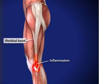 Iliotibial-Band-Syndrome-(ITBS)