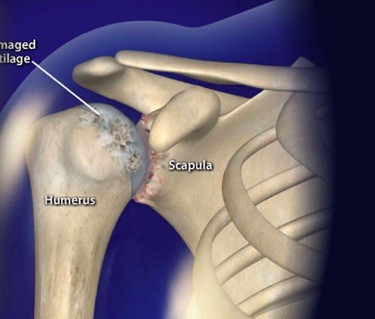 Rheumatoid Arthritis (RA) of the Shoulder