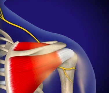 Suprascapular Neuropathy