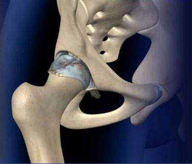 Fluoroscopic Guided Hip Injection
