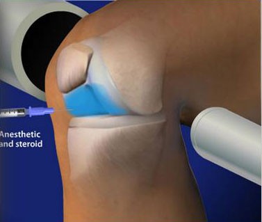 Fluoroscopic Guided Steroid Injection – Knee Pain