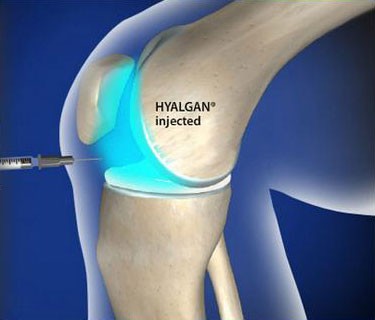 HYALGAN® Injection for Knee Pain (Fluoroscopic Guided)