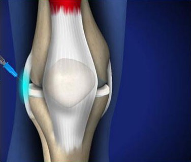 Prolotherapy Treatment for Chronic Knee Pain