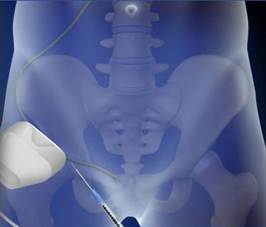 Ultrasound-Guided Ilioinguinal Nerve Block