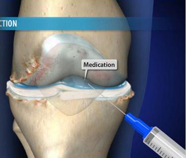 Visco-supplementation for Arthritis of the Knee