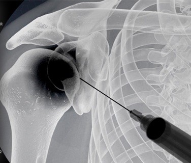 Joint Injection Shoulder