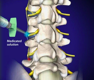 lumbar